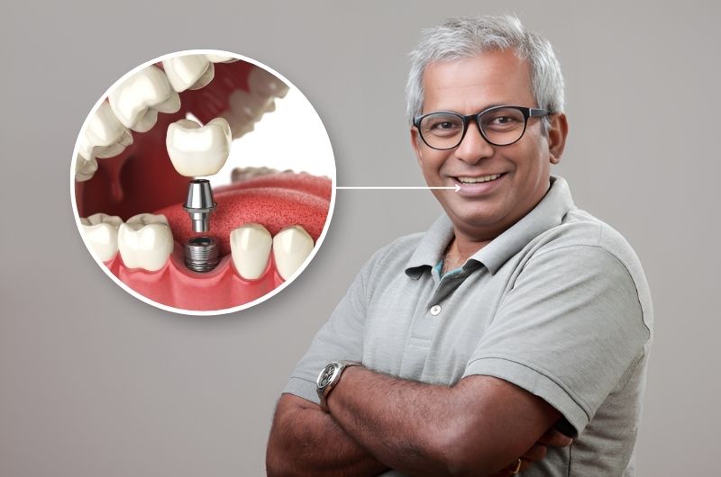 Dental Implants