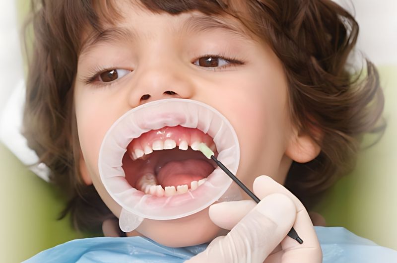 Fluoride Applications and Dental Sealants