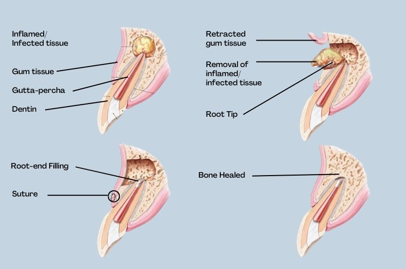 apicectomy