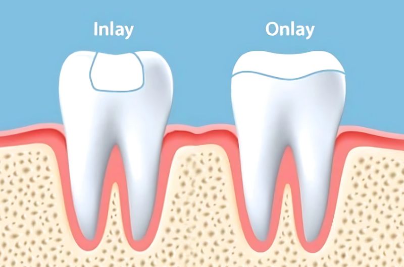 inlays-onlays