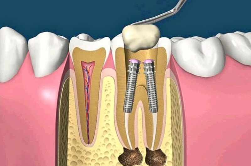 Post and Core