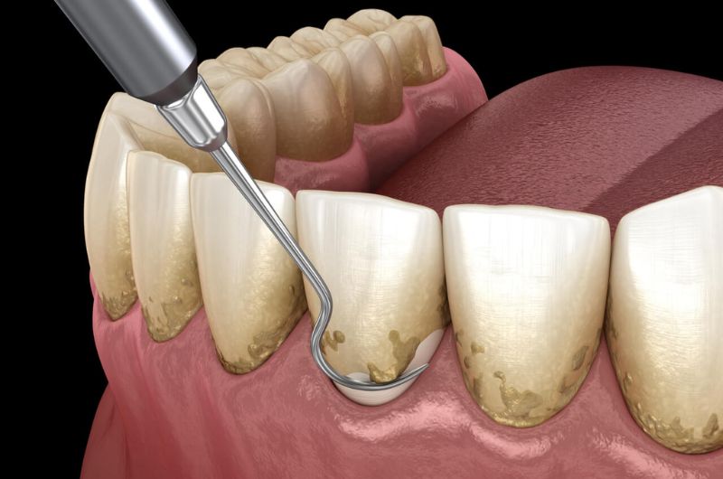 Teeth Cleaning