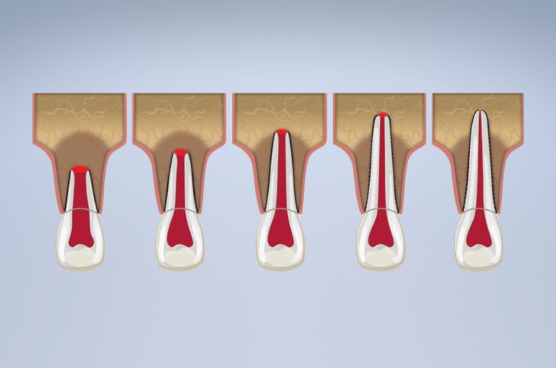 Tooth Root Formative Procedures